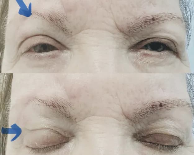 Ботокс для идеального лба: стирая следы времени