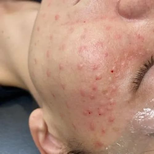 Мезонитный лифтинг: молодость и упругость кожи