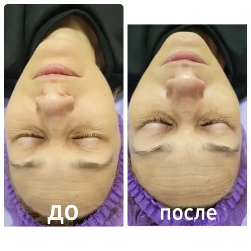 Хімічний пілінг - подаруй собі молодість.