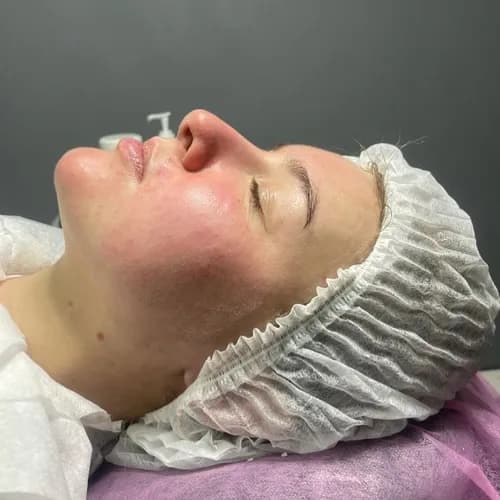 Peeling chemiczny - efekt nie każe na siebie czekać.